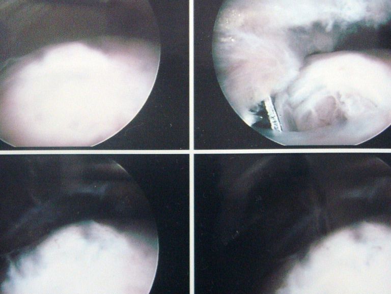 회전근개파열 관절내시경 수술