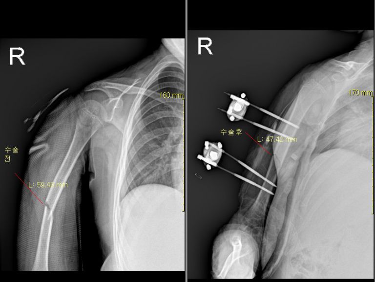 상지 및 수부 외고정술