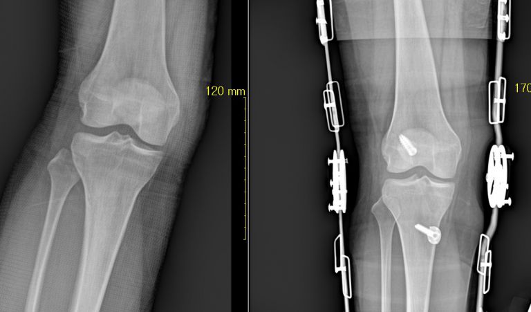 전방십자인대파열 복원술