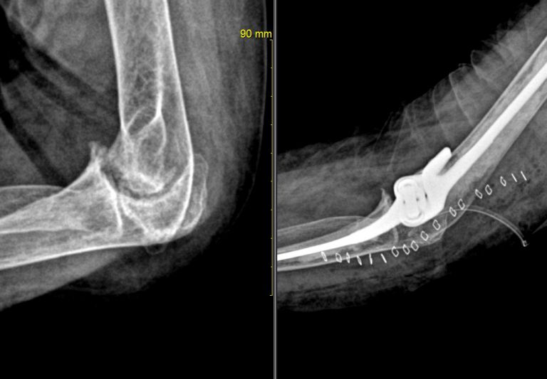 팔꿈치 인공관절