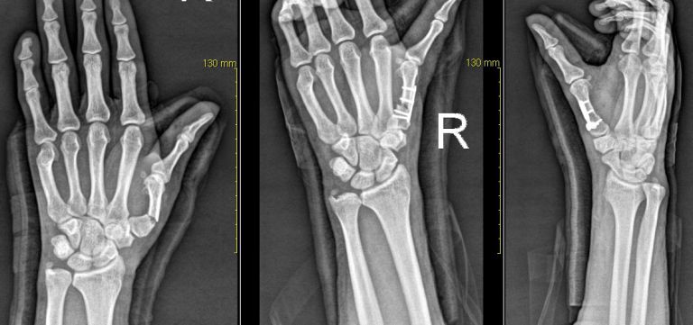 수부 골절 불유합수술