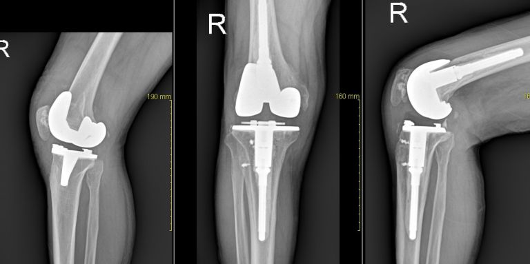 인공관절 재치환술