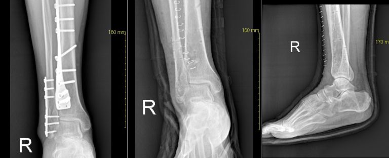 골절 내고정 제거술 