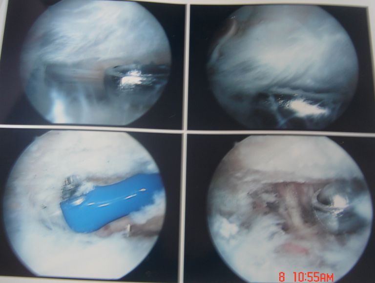 관절와순파열 관절 내시경 수술