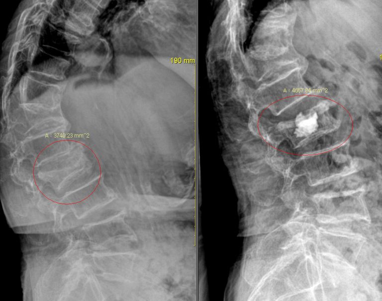 척추 압박골절 성형 수술