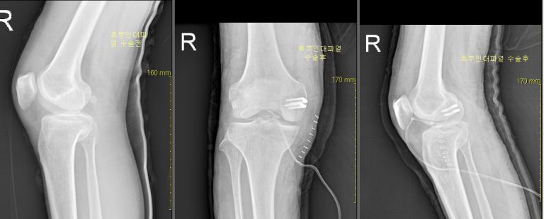 내측 외측 인대 파열