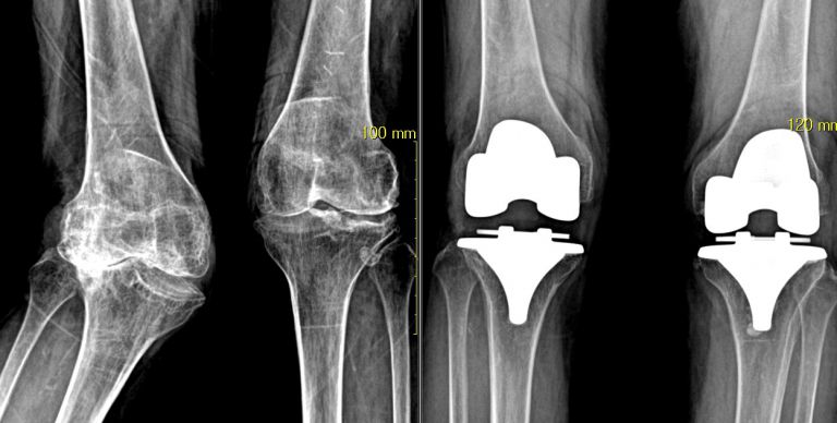 무릎 인공관절