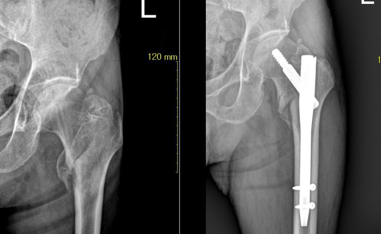 대퇴골 골절