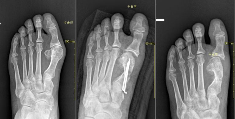 무지 외반증 수술전후  