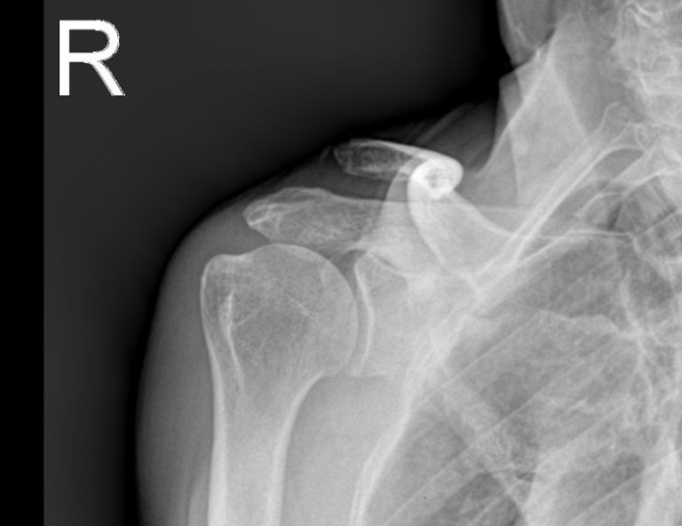 견봉쇄골 관절 탈구 및 회전근개파열 수술