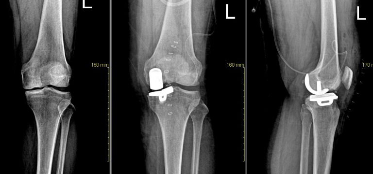 무릎 부분 인공 관절