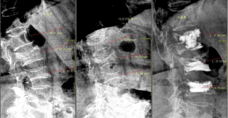 다발성 척추 압박골절 성형수술
