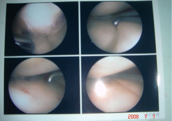 반월상 연골판 파열