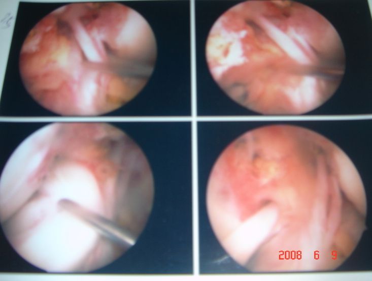 관절내시경 사진