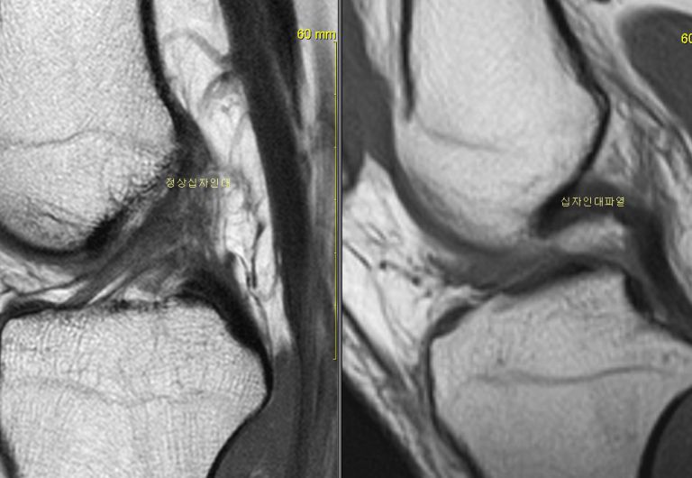 전방십자인대파열 MRI 결과비교