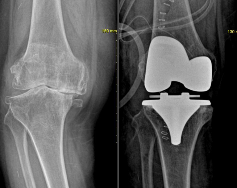 무릎 인공 관절 