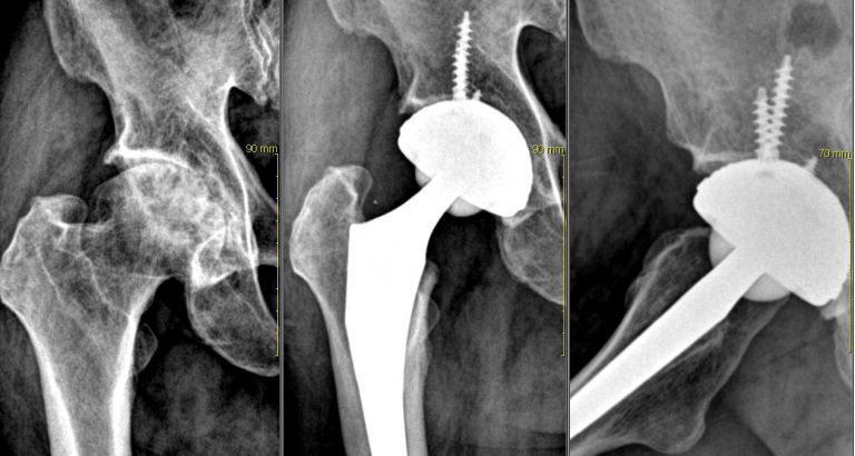 고관절 인공관절