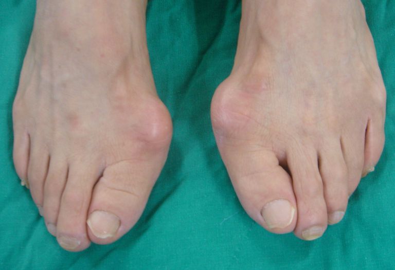 무지외반증 수술전