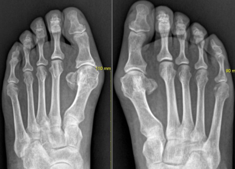 양측 족부 무지 외반증 수술전후 비교